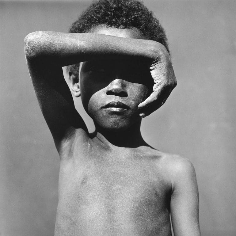 Image- A hunting image of a malnourished Young Somali Refugee. His hand is used to cover his face to prevent the glare of the sun. It shows the consequence of a country ravaged by and natural disaster and Somalia pirates